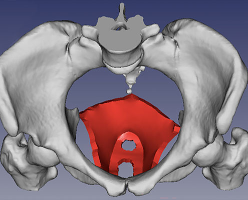 CAD drawing of a Pelvic-floor-muscle-injury design solution